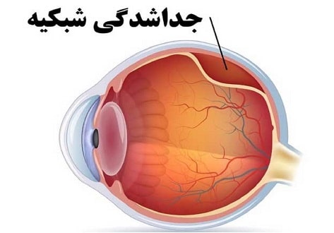 کوروئید چیست؟